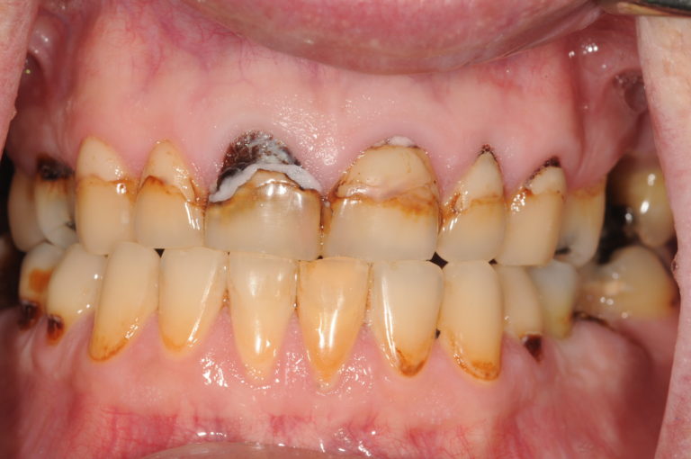 History of Drug Addiction and Losing Teeth - New Smile Prosthodontics