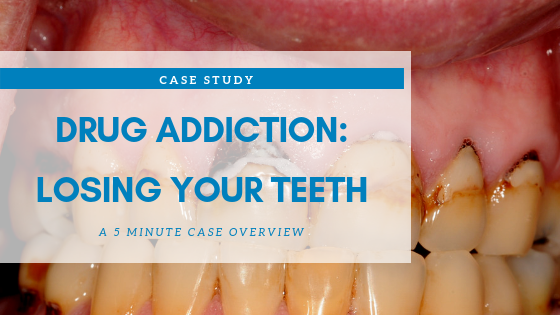 Loosing_teeth_Drug_Meth_Mouth