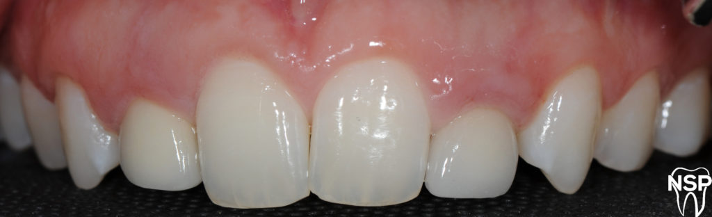 Final_Implant_Provisional_Dr_Alfredo_Paredes