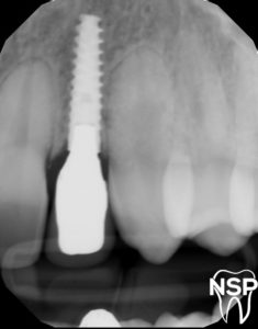Implant_Provisional_XRay_New_Smile_Prosthodontics_Dr._Alfredo_Paredes