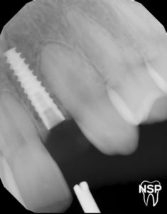 NSP_Smile_Pros_XRAY_Implant_Nobel_Biocare